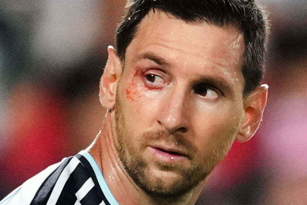 Lionel Messi với vết thương cạnh mắt, ngoái nhìn trong trận tứ kết World Cup giữa Argentina và Thụy Sĩ trên sân Kansas City, bang Missouri, Mỹ ngày 11/7/2026. Ảnh: AP